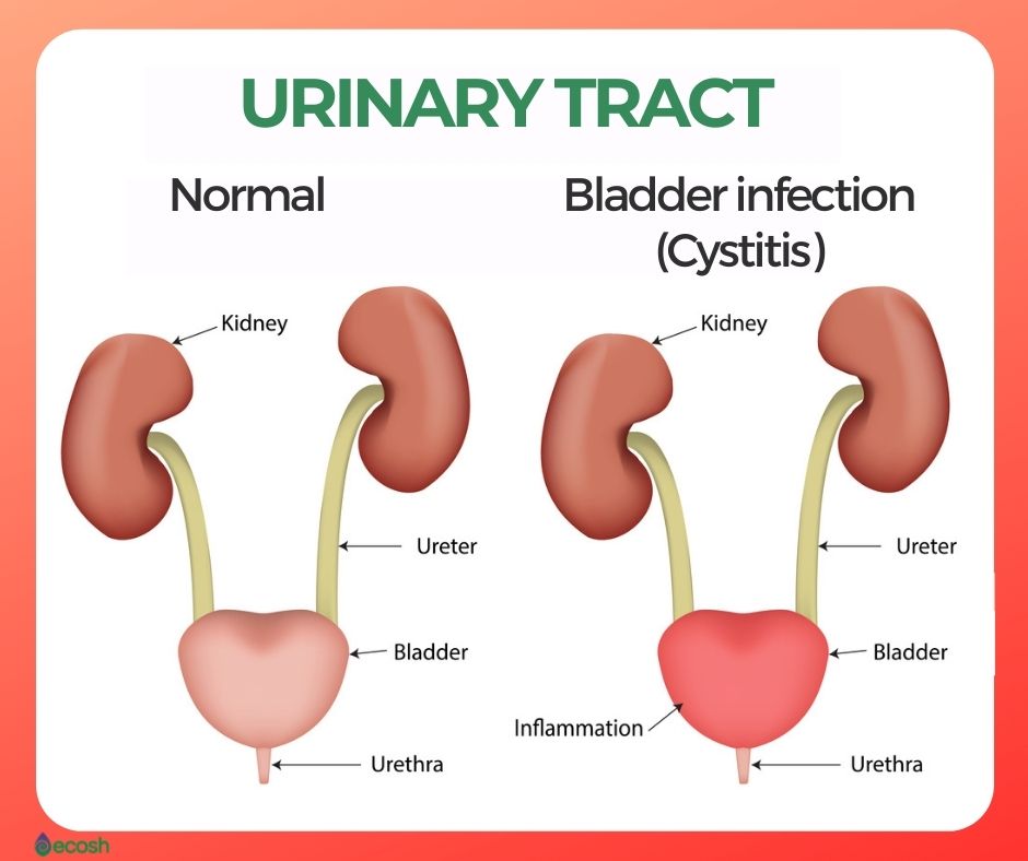 UTI Cystitis Bladder Infection [ECOSH]
